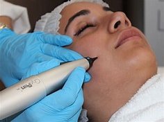 Cryotherapy skin tag removal